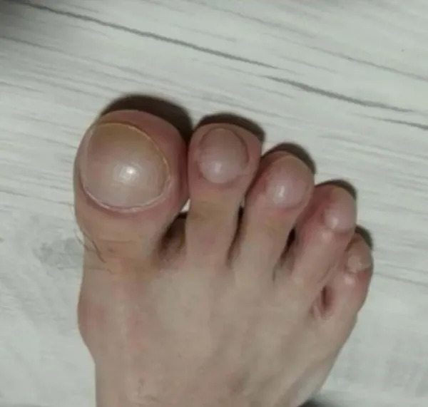 커다란 발가락